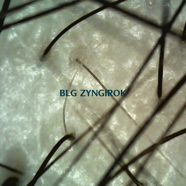 피나모아 복용 28주차 정수리와 이마 사이 부분 두피모습이다.