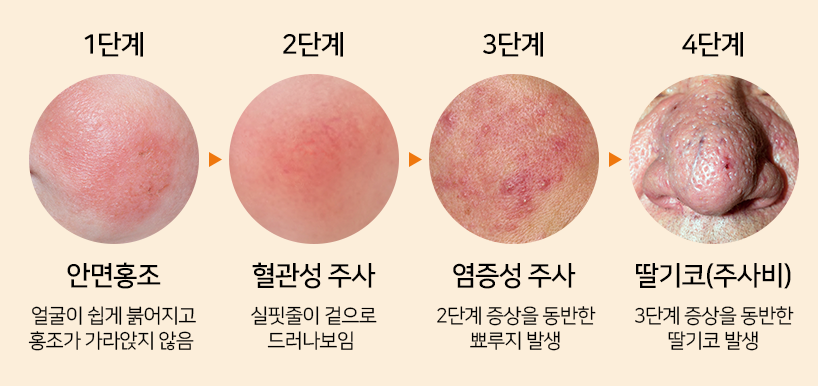 주사 피부염 치료: 각 단계별 접근법을 알아보자
