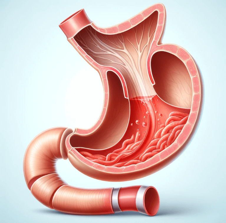 역류성 식도염이란