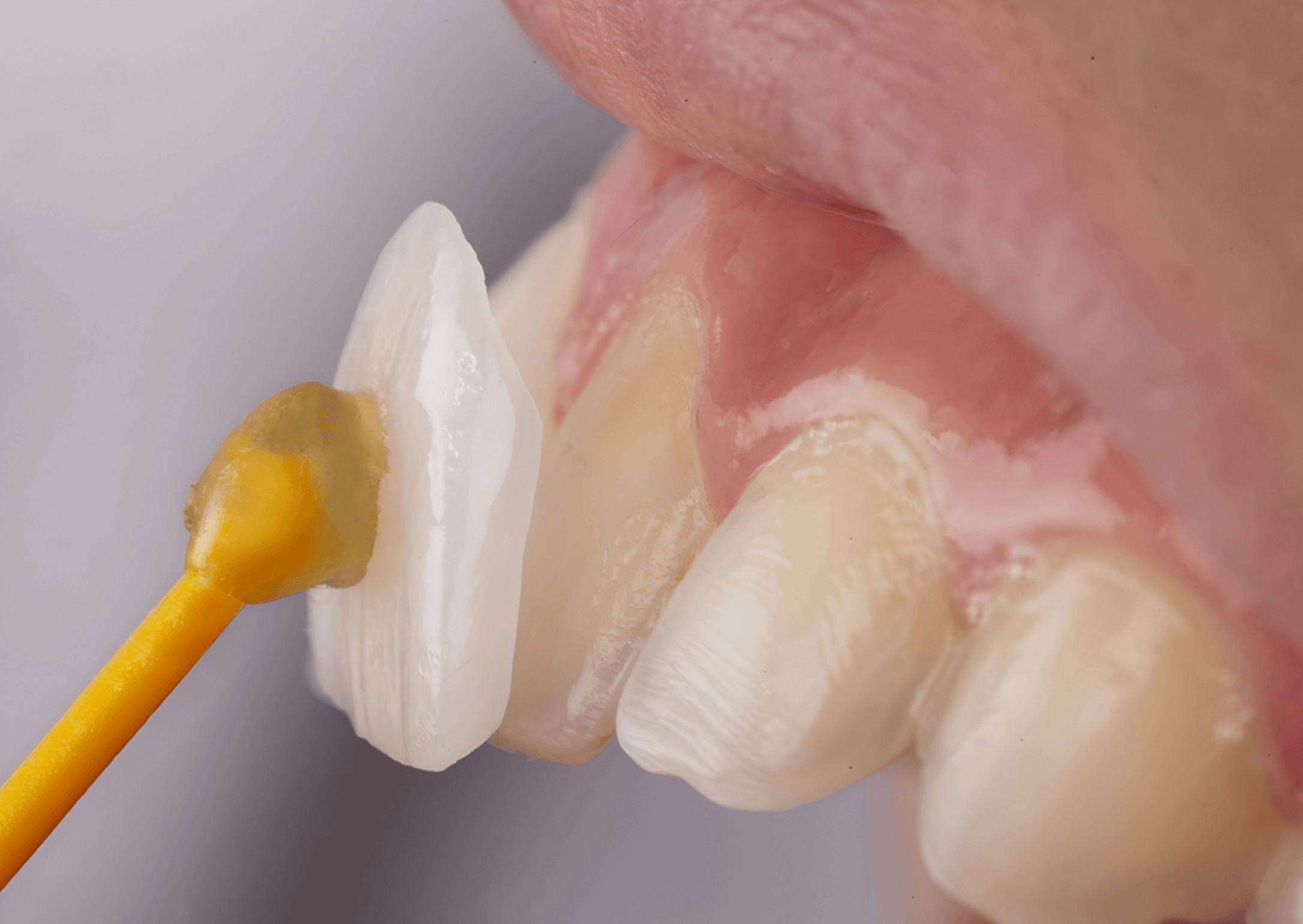 무삭제 라미네이트 착용