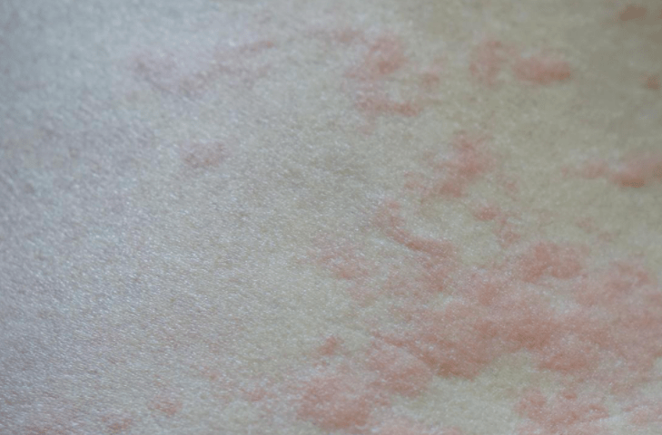 콜린성 두드러기 증상