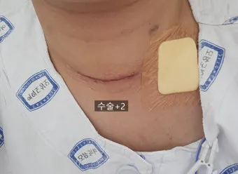 부갑상선기능항진증 수술 후기 2주차 내분비외과 내원 경험담_9