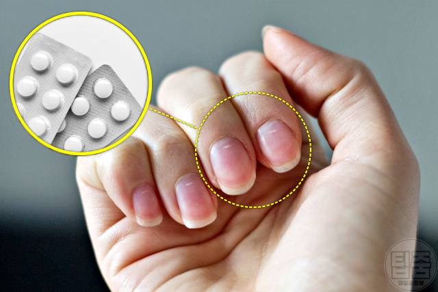 손톱 하얀 반점 손톱흰반점 손톱흰색가로줄 원인 여드름약 레티노이드 면역억제제
