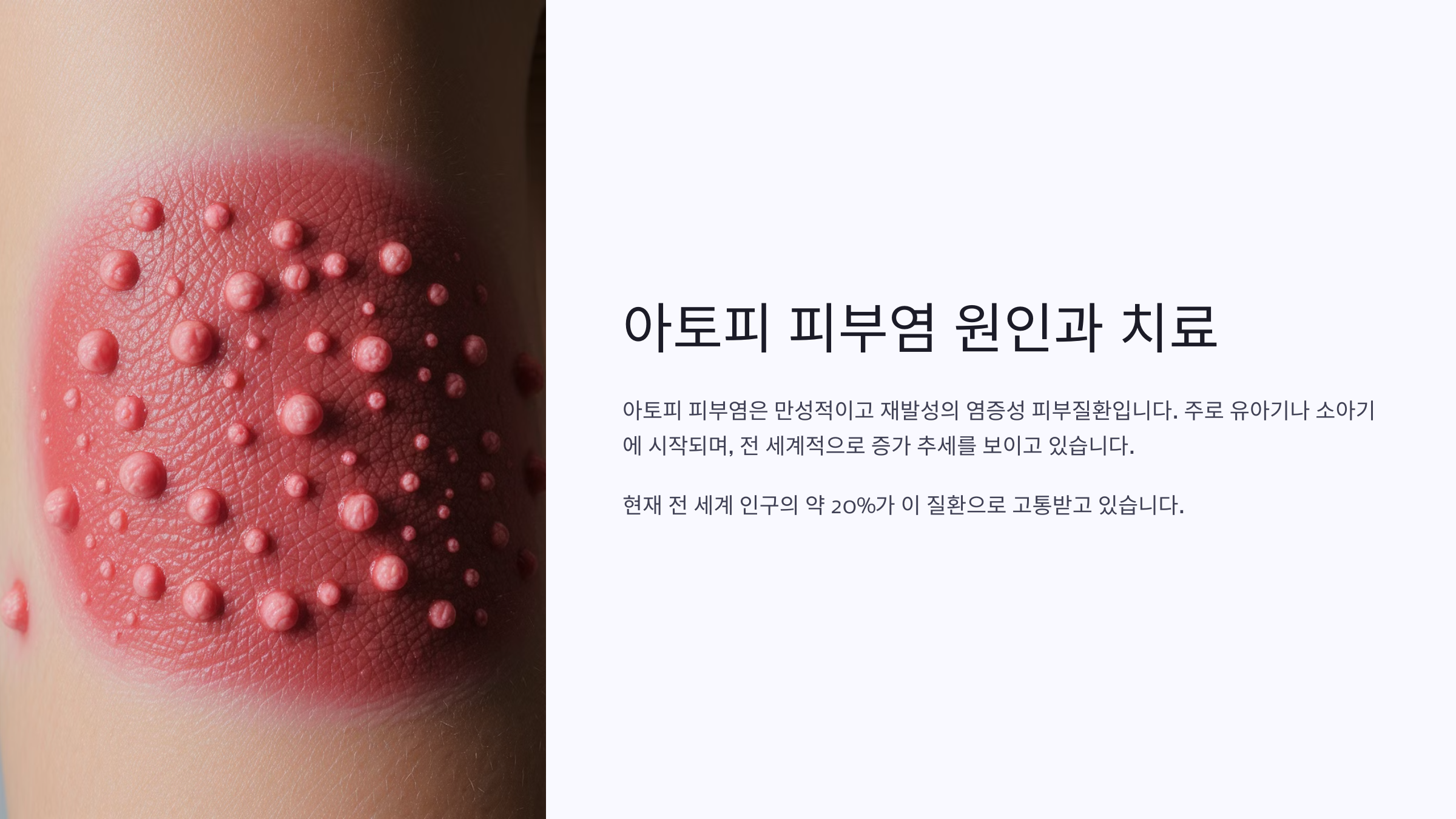 아토피 피부염 원인과 치료