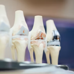 퇴행성 관절염 치료제 예방법 진단기준