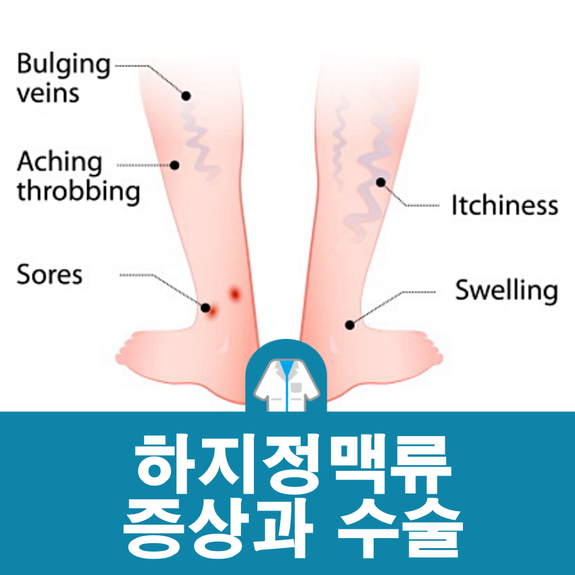 하지정맥류 증상과 수술, 그리고 수술 후 관리에 대하여
