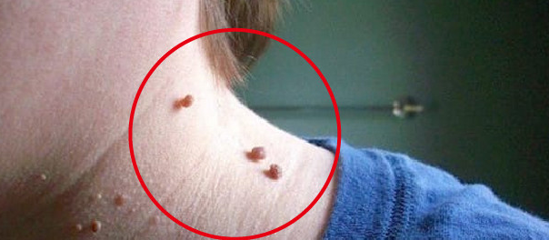 거슬리는 목 쥐젖1