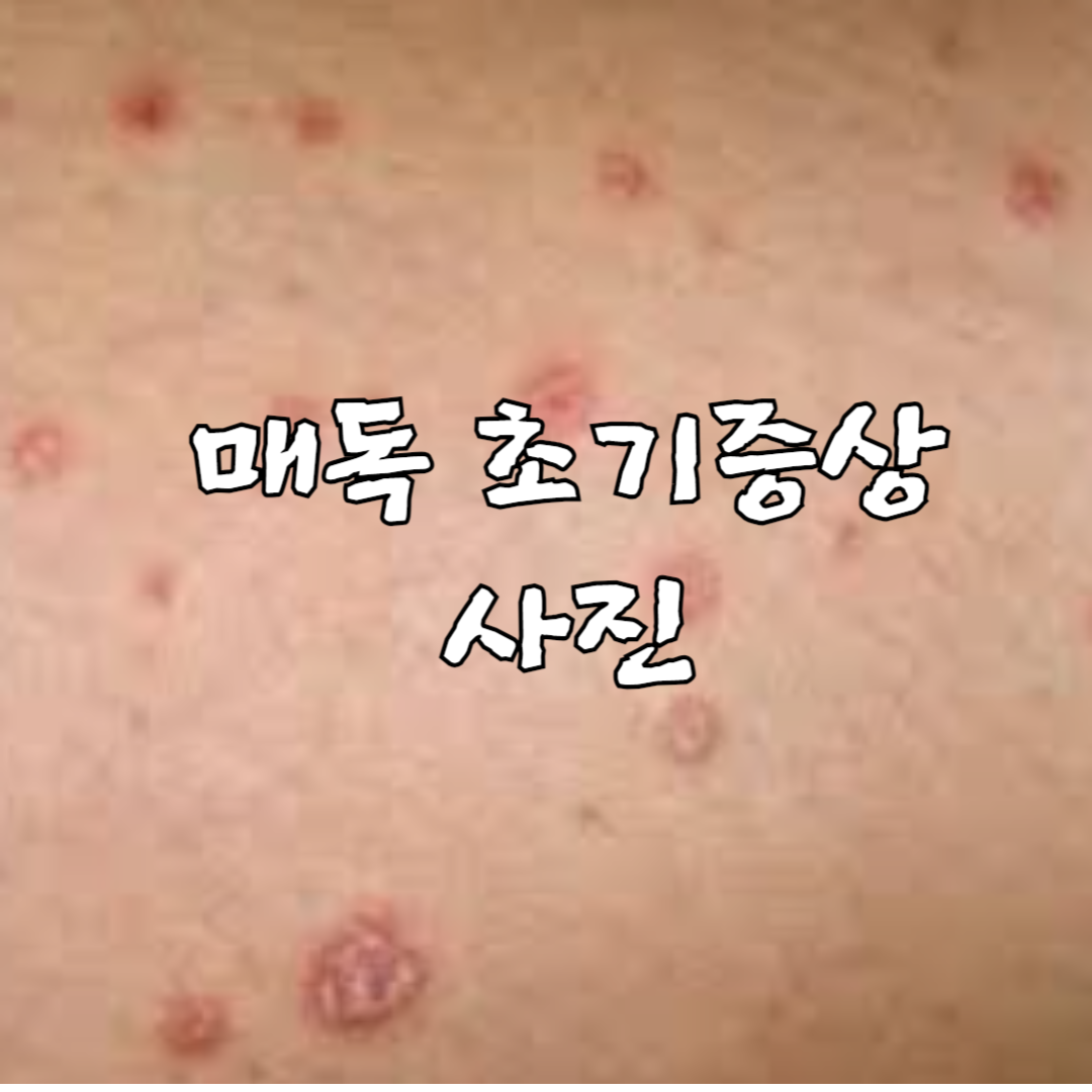 매독 초기증상 사진