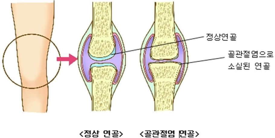 정상 연골과 골관절염 연골
