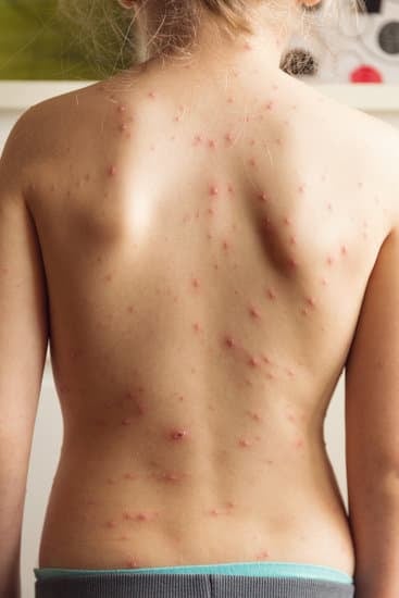 수두(Varicella): 원인, 증상, 치료 및 예방