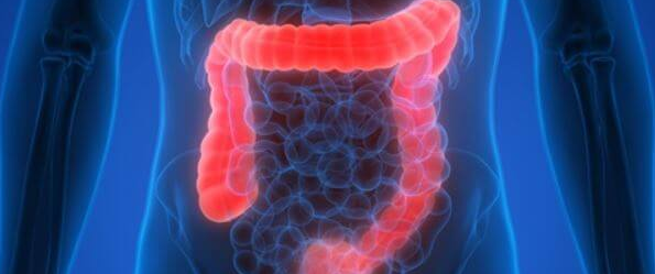 대장암 초기증세1