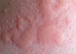 두드러기 원인 2