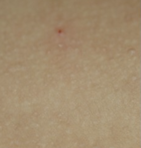 모공각화증이란