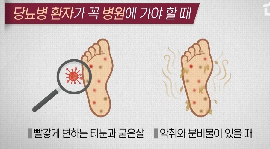 EBS-명의-당뇨발-천동일-교수-당뇨병증상