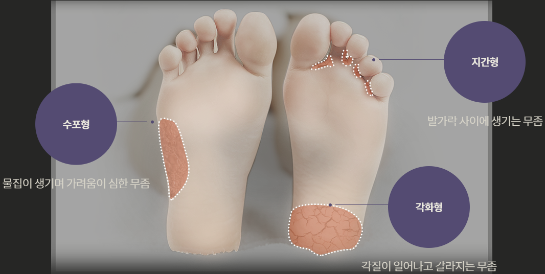 각화성무좀의 증상과 치료