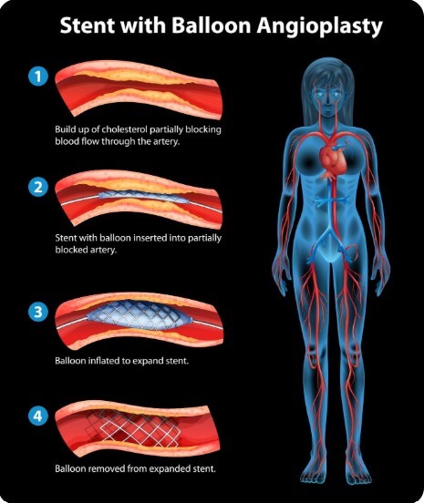 혈관에 막혀 있는 노폐물의 정도를 설명