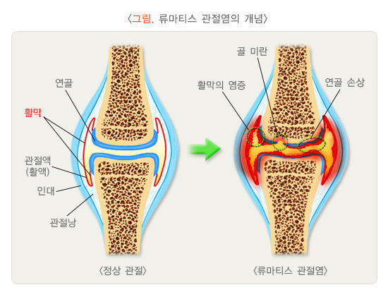류마티스관절염-자가진단법