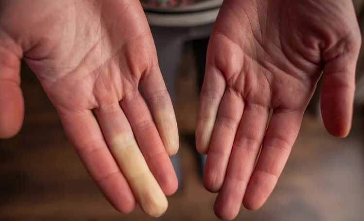 수족냉증 원인 치료법 및 하체 혈액순환 운동 정리