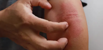 아토피 원인&amp;#44; 증상&amp;#44; 치료법 총 정리 (2025 ver.)