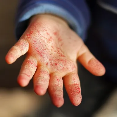 아기 수족구 증상 총정리! 부모가 꼭 알아야 할 팁_1