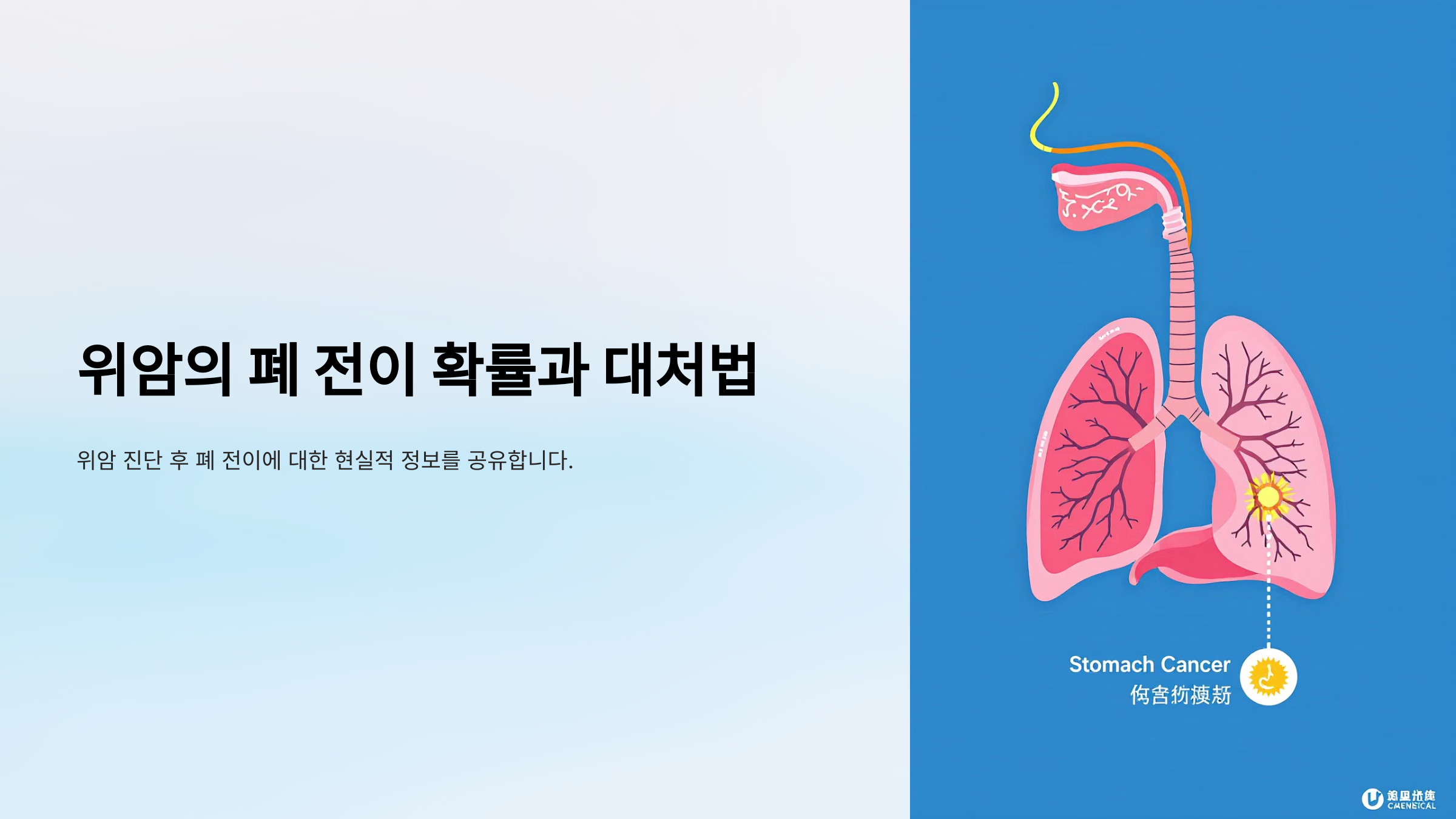 위암의 폐 전이 확률과 대처법