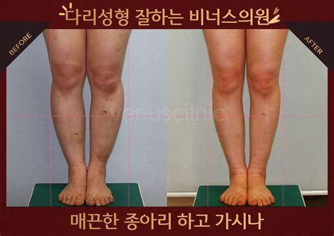 지방흡입술가격