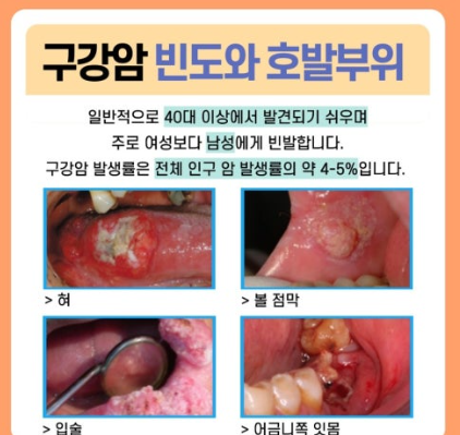 구내염과 구강암 관련 사진