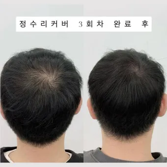 정수리가 아픈 이유와 완화하는 방법_22