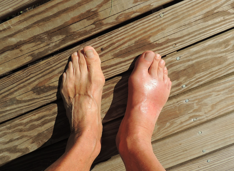 통풍의 원인, 증상과 관리 방법