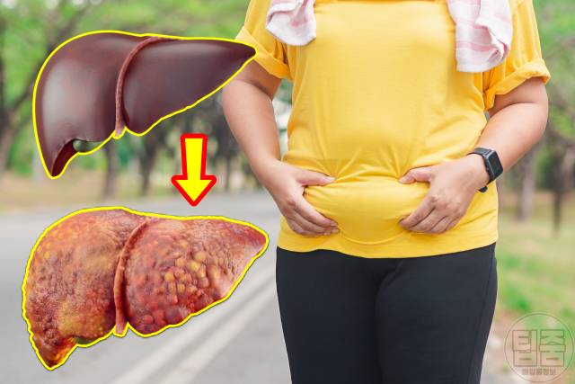 간암 원인 비만 40대 50대 간암 예방법