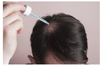 탈모 치료의 최신 트렌드: 약물, 모발 이식, PRP 치료