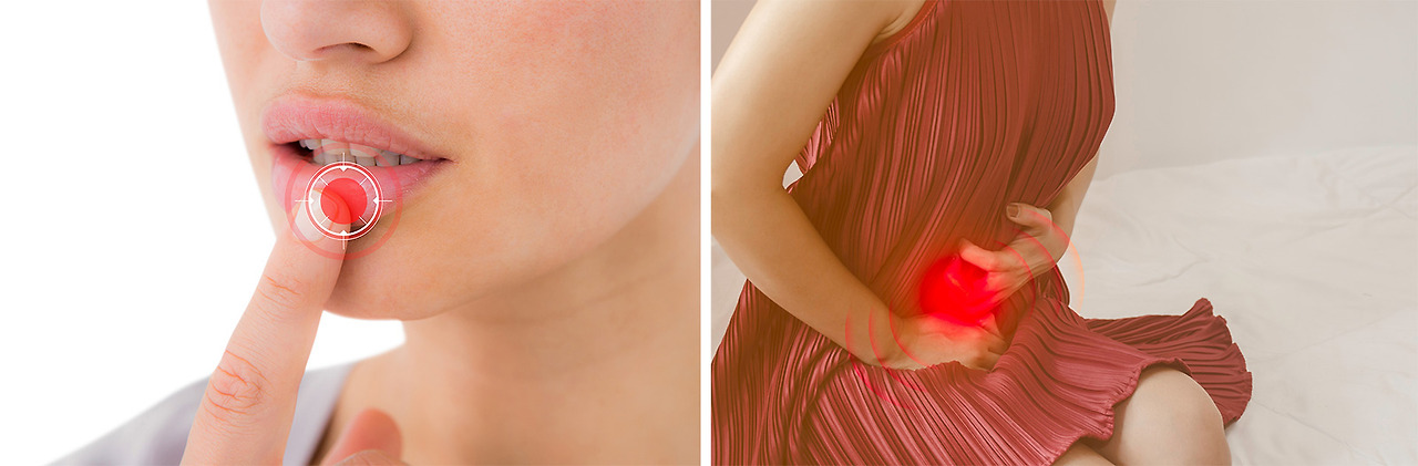 헤르페스 2형 완치