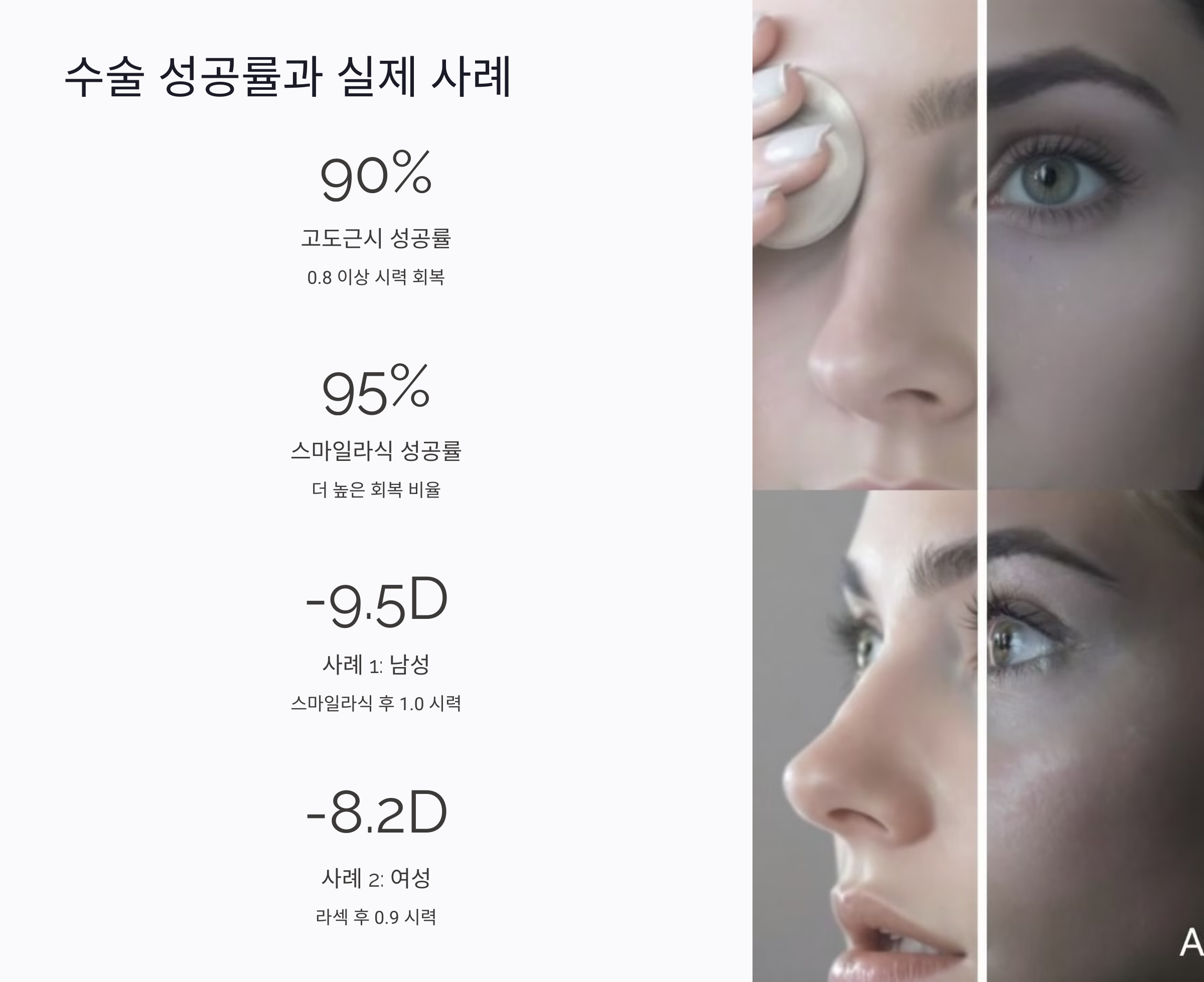 고도근시 라식 후 시력 회복, 어느 정도 좋아질까?