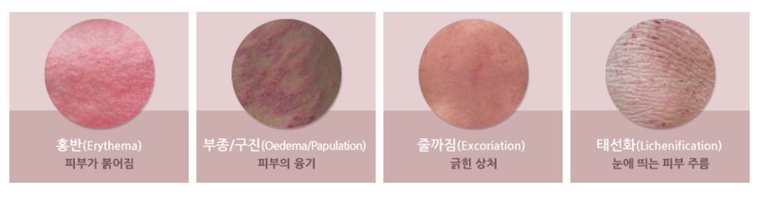 아토피-피부염