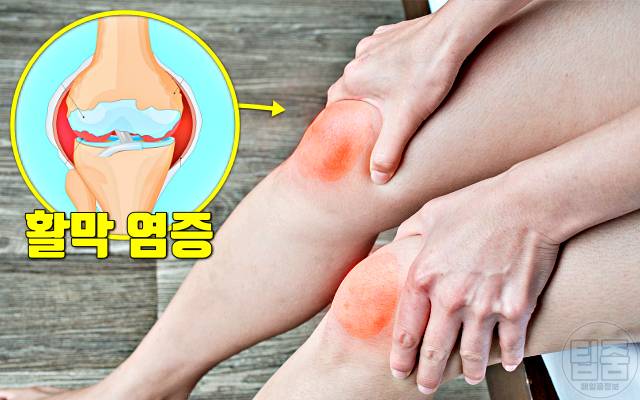 모계유전 질병 류마티스관절염