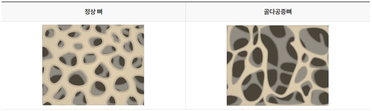 정상뼈의-골밀도와-골다공증뼈의-골밀도를-비교한-사진