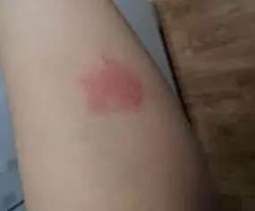 대상포진에-좋은-음식-대상포진-치료법-건강