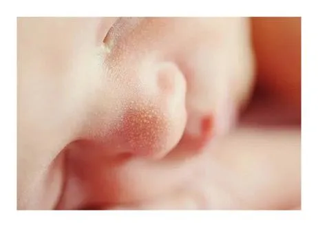 신생아 눈초점
