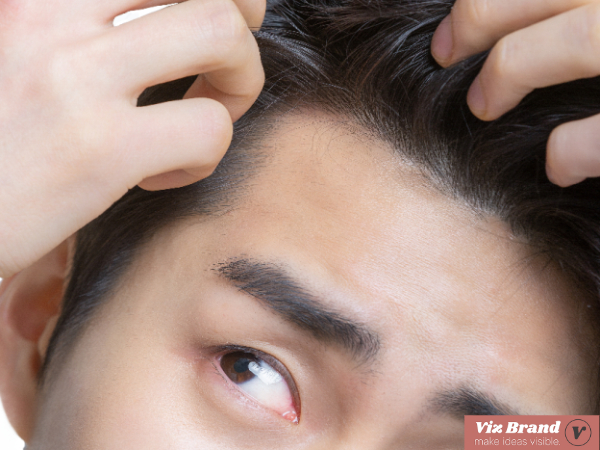 스트레스 탈모 증상 초기 징후와 원인 정리