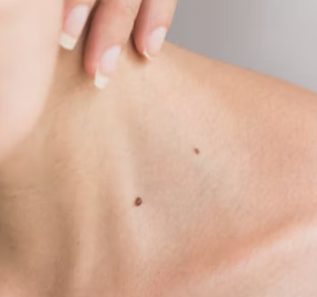 건선 초기 증상 피부염 원인 치료방법