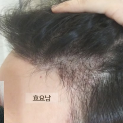 M자 모발이식-2주차-상태-3
