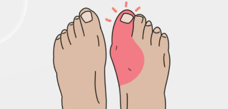 통풍 관련 사진