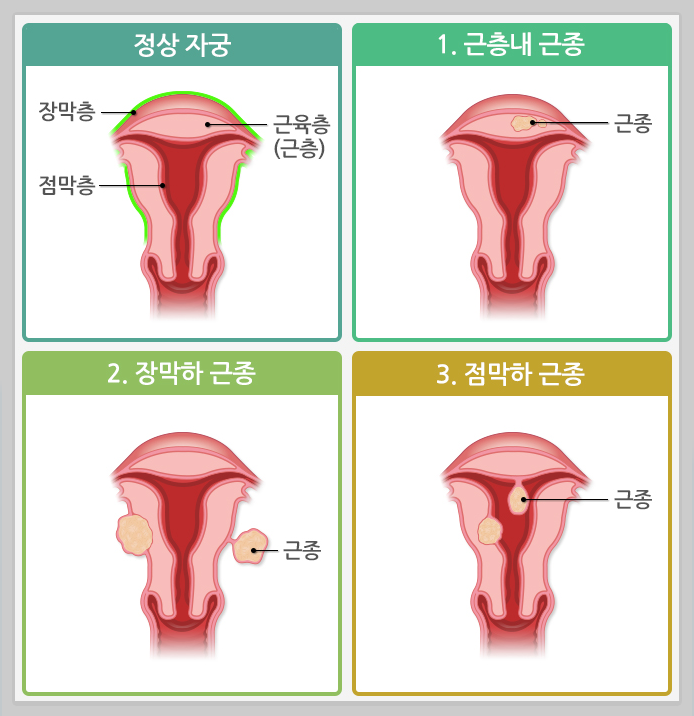 자궁근종 종류