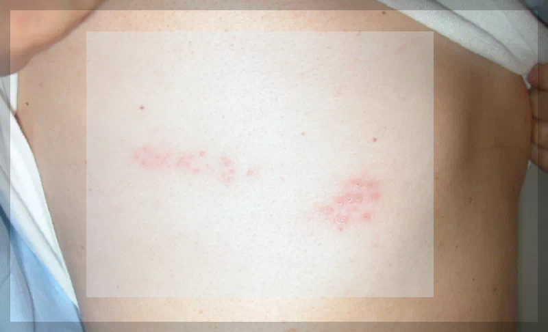 파종성 대상포진