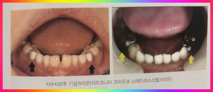 지르코니아 크라운 및 스테인레스 크라운 비교