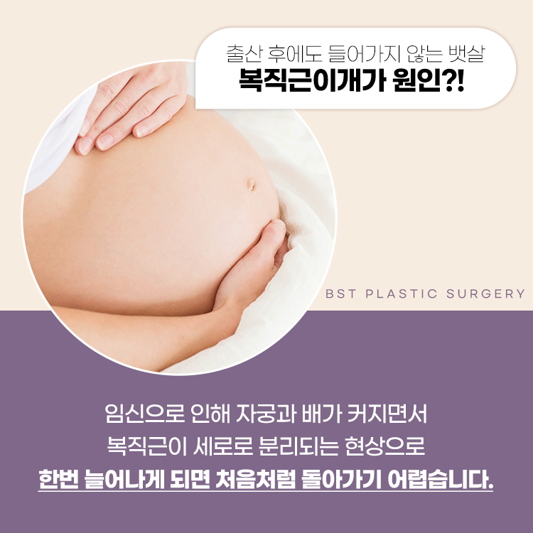 임신으로 인해 자궁과 배가 커지면서
복직근이 세로로 분리되는 현상으로
한번 늘어나게 되면 처음처럼 돌아가기 어렵습니다.