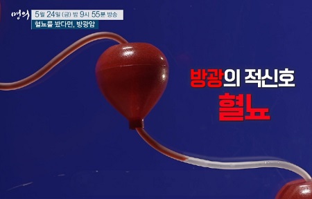 방광적신호-혈뇨