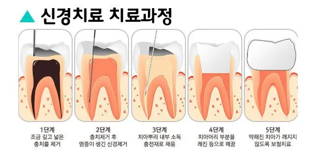 치아 신경치료의 과정을 잘 나타내는 그림이다.