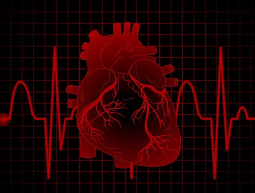 심근경색 사진입니다.