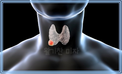 임신 중 갑상선암 7가지 알아둘점